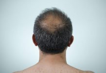 Este medicamento pode travar calvície