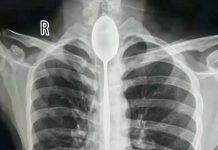 Homem teve um ano com uma colher no esófago sem saber