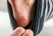 Furar as bolhas em casa é seguro, mas só se o fizer assim